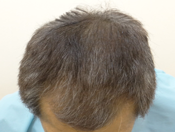 薄毛治療 発毛症例 55歳/MO型/7ヶ月後