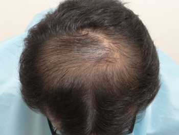薄毛治療 発毛症例 31歳/O型/6ヶ月後