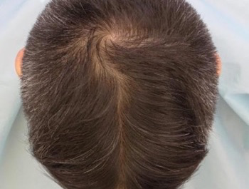 薄毛治療 発毛症例 55歳/MO型/7ヶ月後