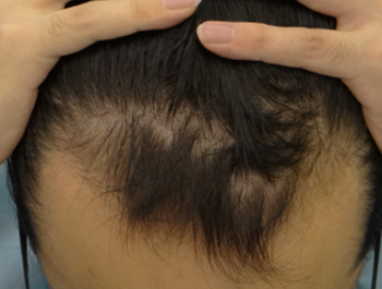 薄毛治療 発毛症例 23歳/M型/6ヶ月後