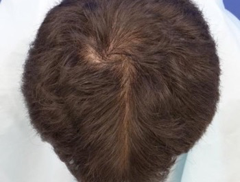 薄毛治療 発毛症例 31歳/MO型/7ヶ月後