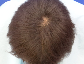 薄毛治療 発毛症例 22歳/O型/5ヶ月後