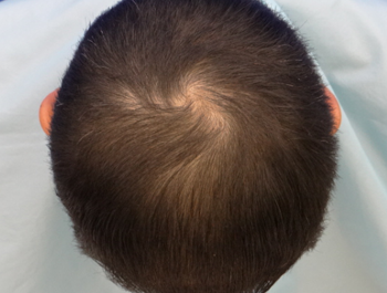 薄毛治療 発毛症例 39歳/MO型/6ヶ月後