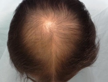 薄毛治療 発毛症例 44歳/MO型/初診時