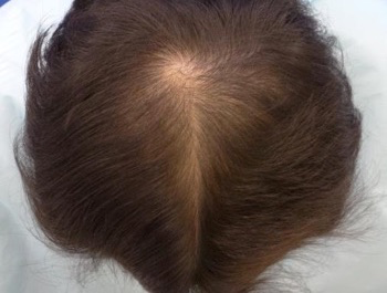 薄毛治療 発毛症例 44歳/MO型/7ヶ月後