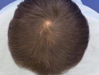 薄毛治療 発毛症例 51歳/MO型/5ヶ月後