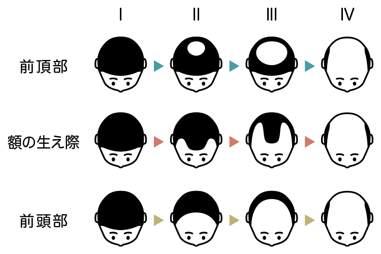 AGAによる薄毛の進行パターン