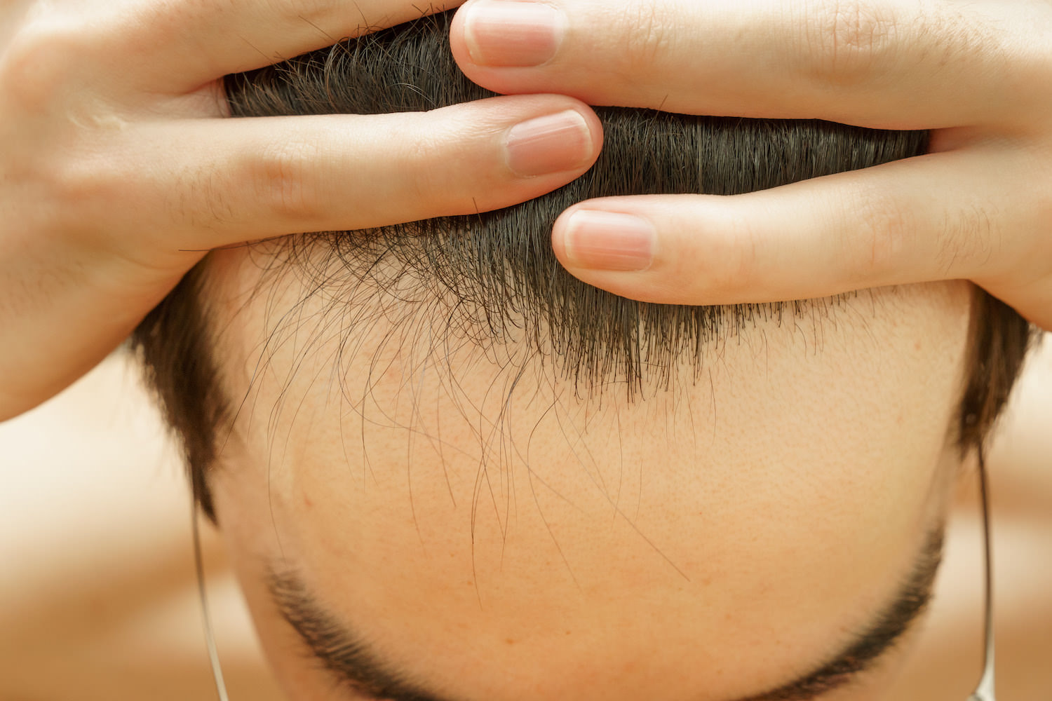 おでこの生え際が痛い 頭皮が出すシグナルは男性がハゲる前兆 ヘアメディカル