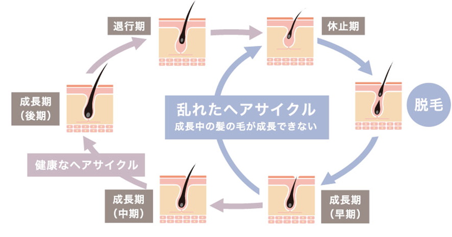 抜け毛を毛根から解析 根本に白い塊のついた毛と黒い毛は危険信号 ヘアメディカル By Dクリニック